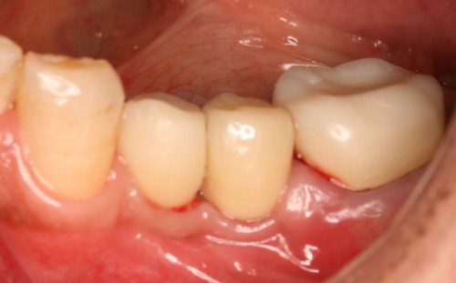 西本6 上部構造装着後　歯肉の盛り上がり